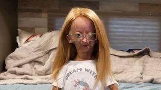 Adalia Rose Williams, the YouTuber who inspired the Benjamin Button movie, has died