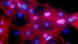 Primeros pasos de la inmunoterapia contra el cáncer de mama