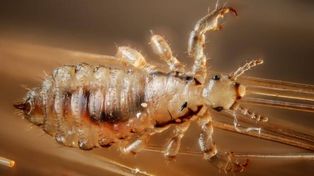 Hay coronavirus pero también menos piojos: la pediculosis se redujo durante la cuarentena