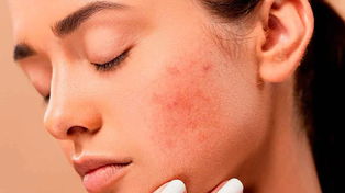 Dermatitis atópica, una enfermedad que marca la piel