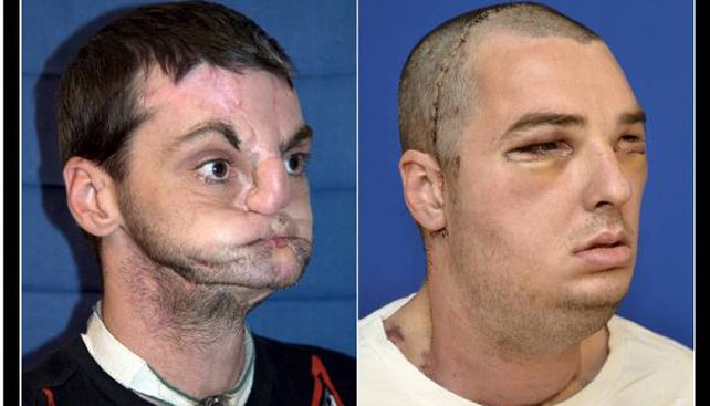 Realizan el transplante de rostro m&aacute;s completo de la historia en Estados Unidos