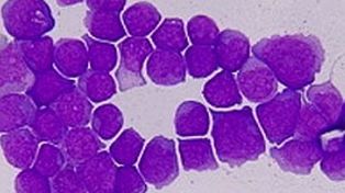 Sospechan que el c&aacute;ncer presenta mutaciones &uacute;nicas en cada enfermo