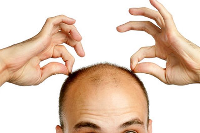 Chau mito: la calvicie común es herencia de la madre y no del padre