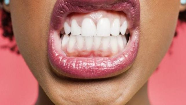 Blancorexia: los peligros que reviste la obsesión por dientes más blancos