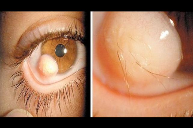 El raro caso del hombre de las pupilas peludas