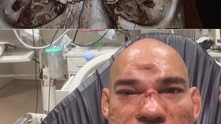 Un luchador sufrió fractura de cráneo y terminó con la frente hundida tras un esperado combate