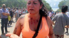 A LOS TIROS. Una mujer muestra las marcas que las balas de goma policiales dejaron sobre su cuerpo. A LOS TIROS. Una mujer muestra las marcas que las balas de goma policiales dejaron sobre su cuerpo.